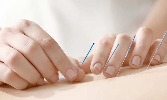 Acupuncture Dry Needling Aside Image